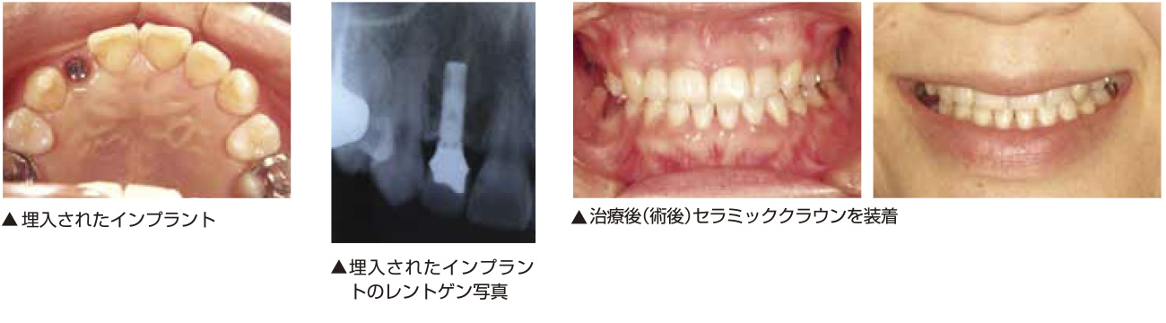 症例1［一歯欠損の場合のシングルスタンディングインプラント］